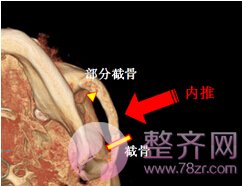 什么是无下垂颧骨移动术?