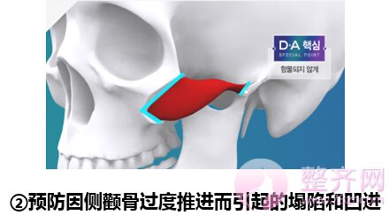 无下垂颧骨移动术3大亮点
