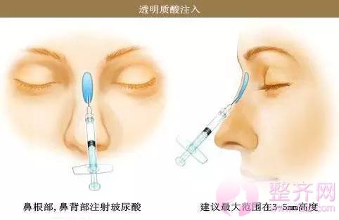 关于鼻部整形,重要性超乎你的想象力