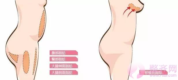 自体脂肪丰胸,脂肪才是重点