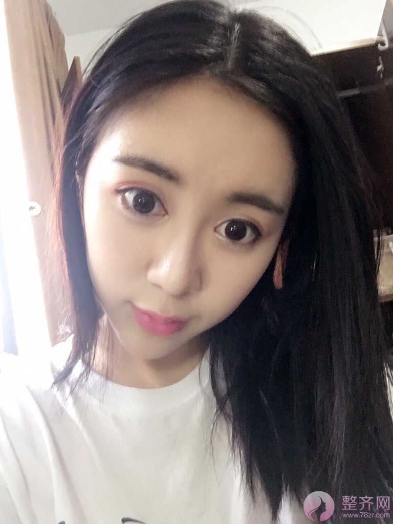 玻尿酸也是需要谨慎选择