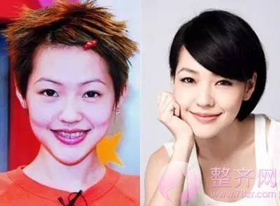 什么样的牙齿需要做正畸呢?