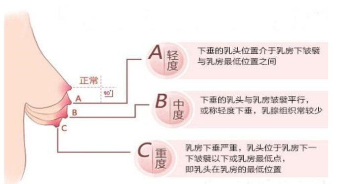 乳房下垂矫正的方法有哪些?