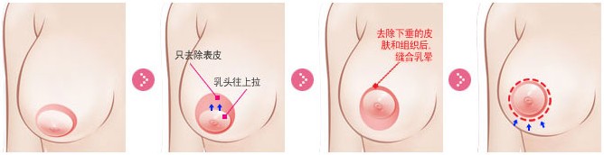 乳房下垂矫正的方法有哪些?