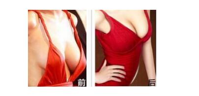 乳房下垂矫正的方法有哪些?