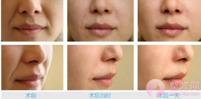 玻尿酸果怎么延长?