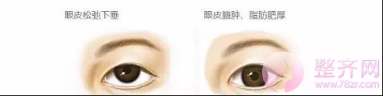 单眼皮和双眼皮的区别是什么?