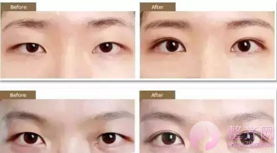 单眼皮和双眼皮的区别是什么?