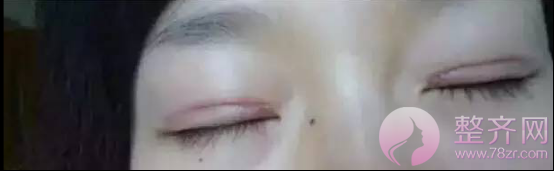 单眼皮和双眼皮的区别是什么?