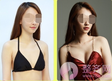 自体脂肪隆胸是否没问题?