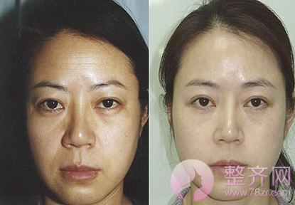 什么是较准埋线提升悬吊抗衰术?