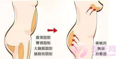 自体脂肪移植,该瘦的地方瘦,该美的地方美!