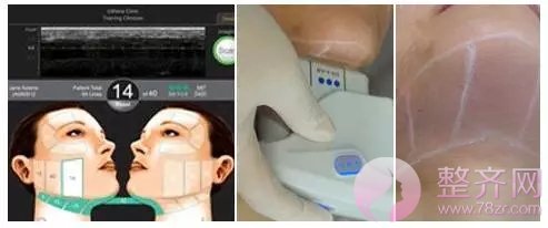 超声提拉+埋线提升让岁月无限延缓!