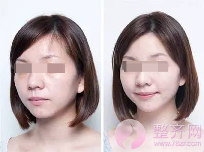 你和女神的差距,只有一支玻尿酸的距离!