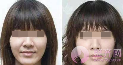 你和女神的差距,只有一支玻尿酸的距离!