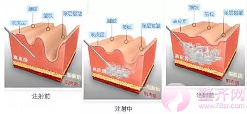 你和女神的差距,只有一支玻尿酸的距离!