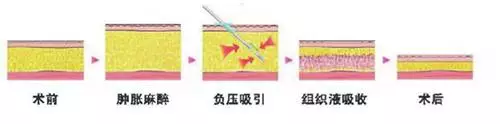 吸脂,你真的了解吗?