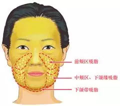 吸脂,你真的了解吗?