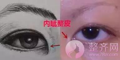 如何判断自己需不需要开眼角?