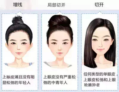 什么样的双眼皮较适合你?