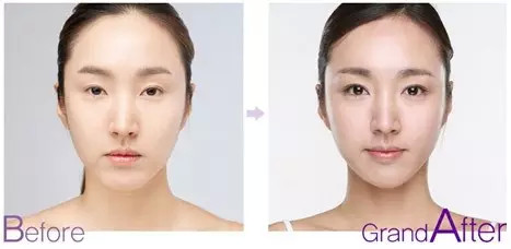 什么样的双眼皮较适合你?