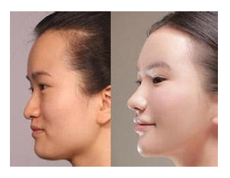 郑州集美美容医院假体隆鼻多少钱?