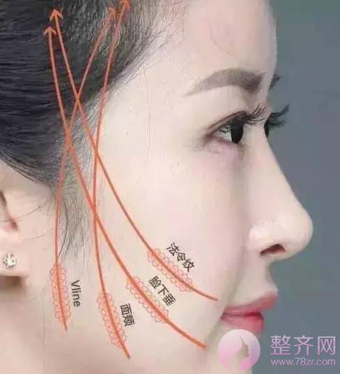 为什么要做面部埋线提升?