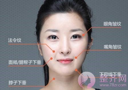 为什么要做面部埋线提升?