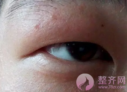 为什么有的双眼皮消肿就是比别人慢呢?