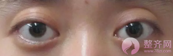为什么有的双眼皮消肿就是比别人慢呢?