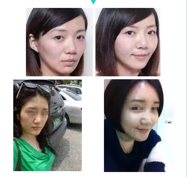 面部松弛毁所有,女神如何抗“老”