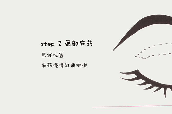 做双眼皮你怕了么!!!