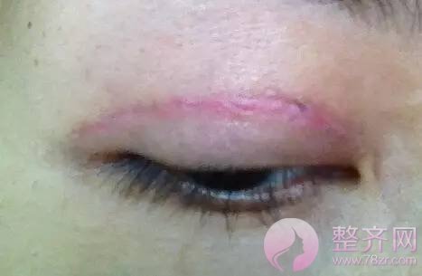 做双眼皮你怕了么!!!