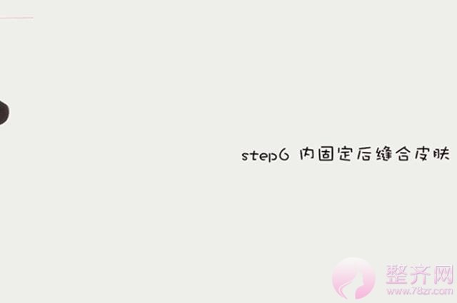 做双眼皮你怕了么!!!