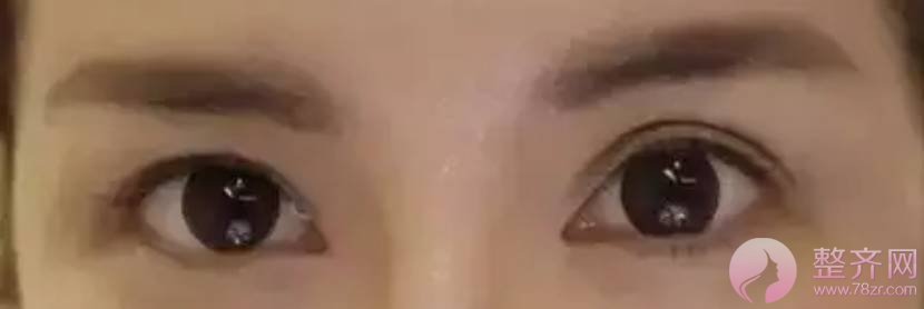 做双眼皮你怕了么!!!