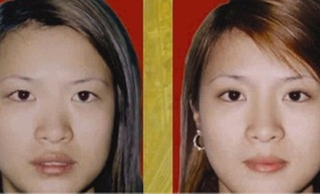 米扬丽格隆鼻子多少钱?