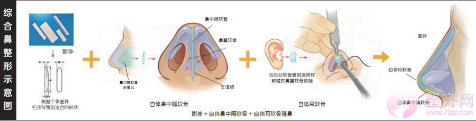 什么是鼻部手术手术?