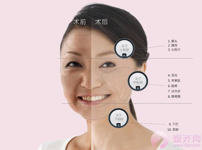 什么是埋线提升提升?