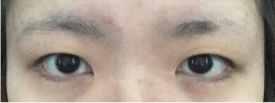 隋医生做的全切双眼皮手术