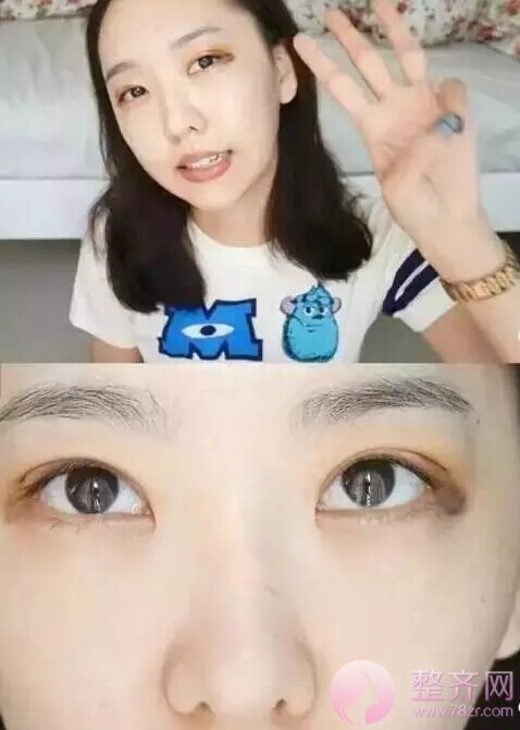 网红直播割双眼皮,美出一片天