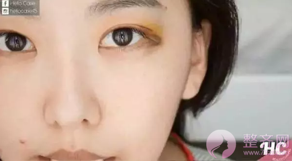 网红直播割双眼皮,美出一片天