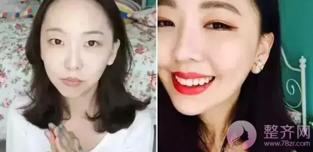 网红直播割双眼皮,美出一片天