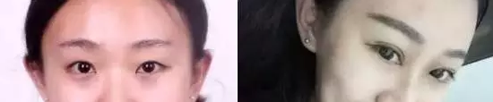 网红直播割双眼皮,美出一片天