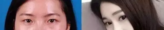 网红直播割双眼皮,美出一片天
