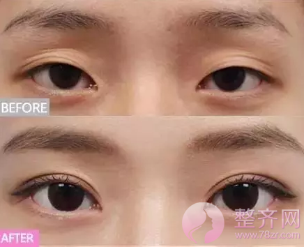 网红直播割双眼皮,美出一片天