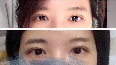上海九院刘菲医生做的全切双眼皮手术果