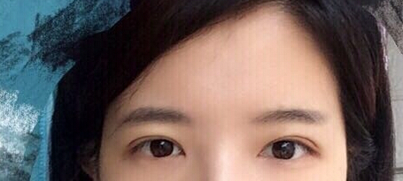 上海九院刘菲医生做的全切双眼皮手术果