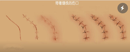 伤口长不长疤,一半与医生有关,一半与患者体