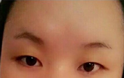 【案例分享】做了双眼皮手术以后眼睛变小了?