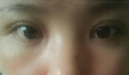 【案例分享】做了双眼皮手术以后眼睛变小了?